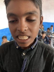 Brown teeth due to dental fluorosis from high fluoride levels in water. Photo: Radhika Iyengar