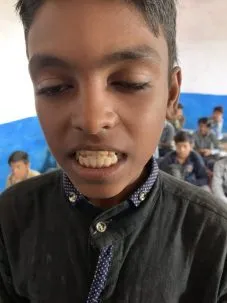 Brown teeth due to dental fluorosis from high fluoride levels in water. Photo: Radhika Iyengar